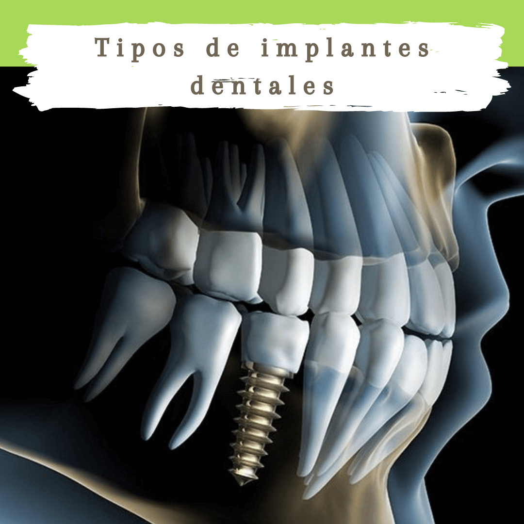 No todos los implantes dentales son iguales.