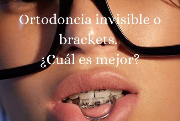 Ortodoncia invisible o brackets. ¿Cuál es mejor?