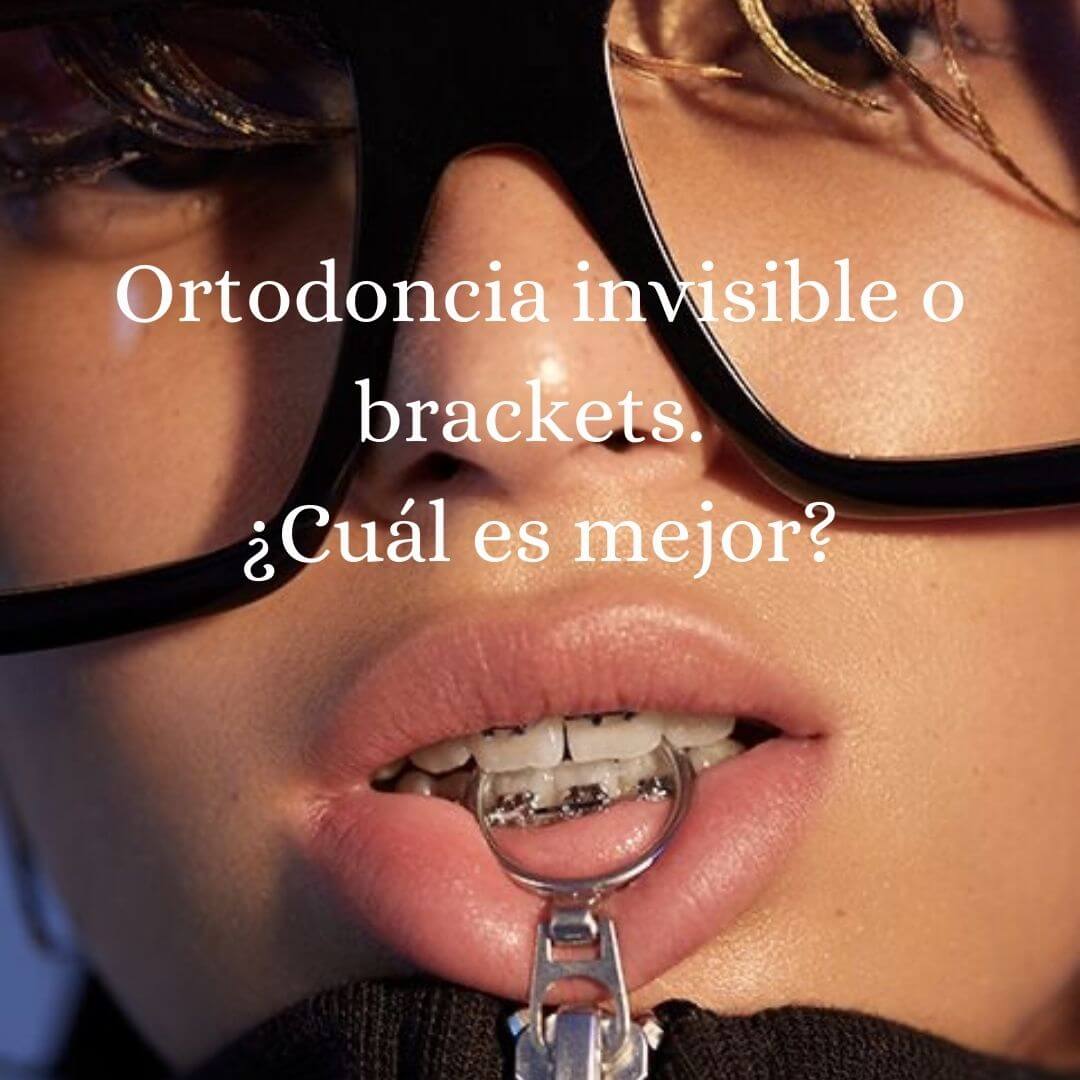 Ortodoncia invisible o brackets. ¿Cuál es mejor?
