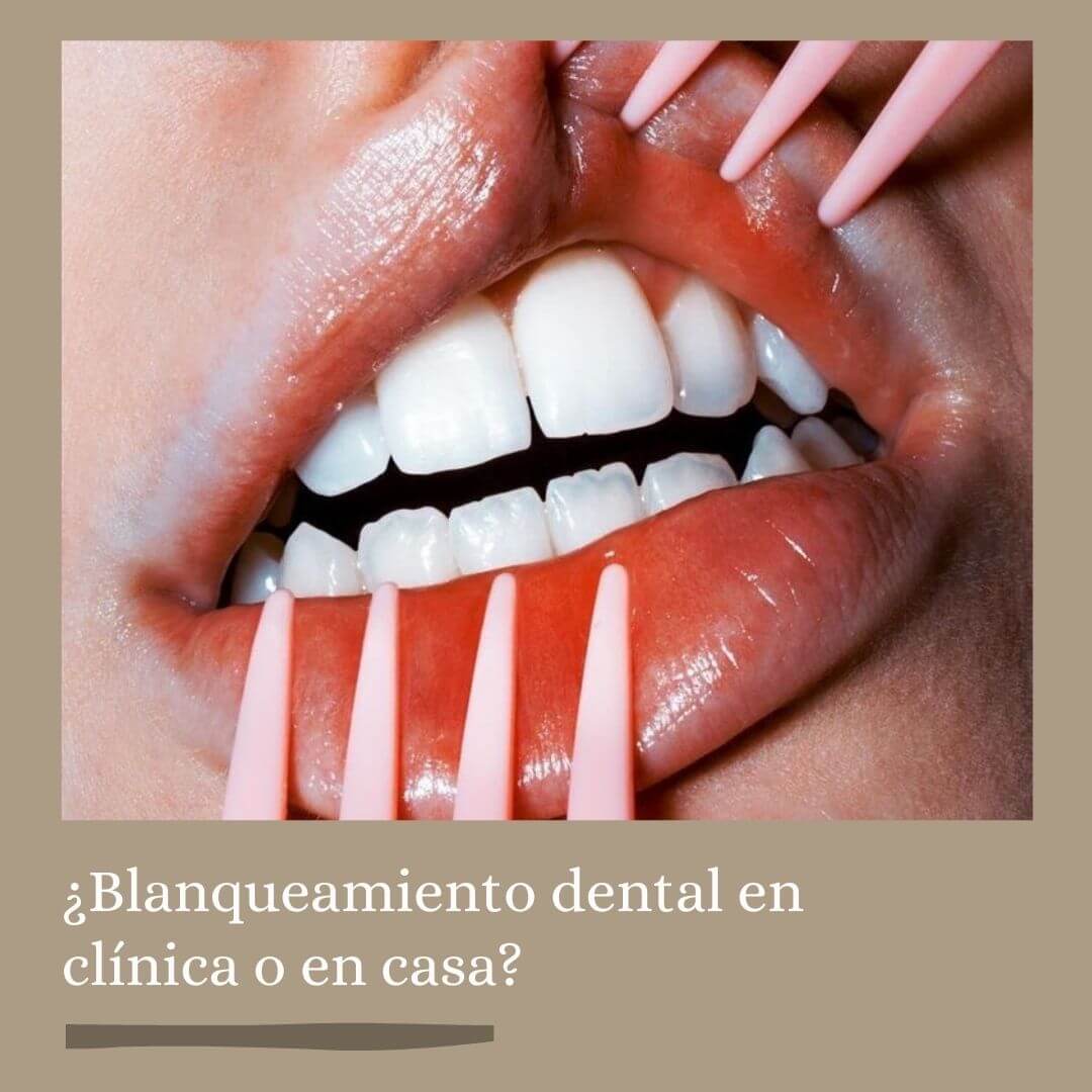 ¿Blanqueamiento dental en clínica o en casa?