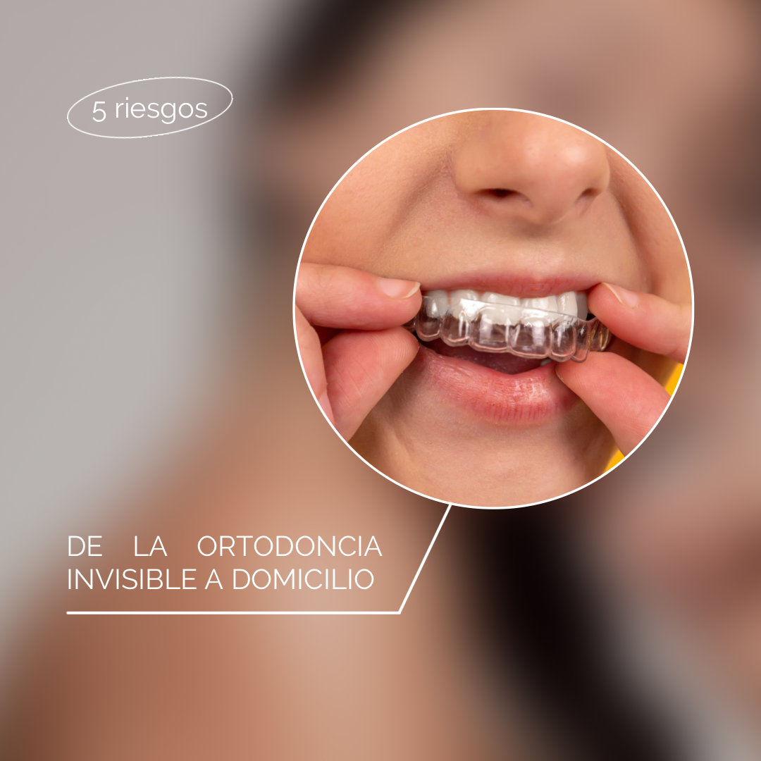 5 Riesgos de la ortodoncia invisible a domicilio.